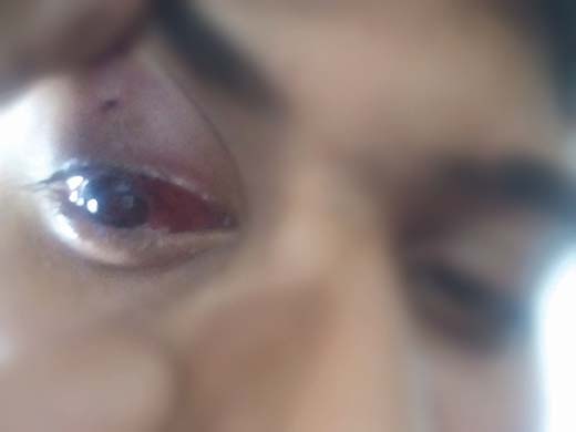Arman, 18, while  showing his  bloodied eye which was hit by pellets on May 22, 2015.