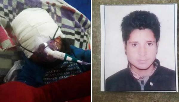 Suhail Ahmad (l: after pellet injuries)