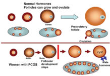 Polycystic Ovary Syndrome (PCOS): The ‘Silent Disorder’ in Kashmiri Women
