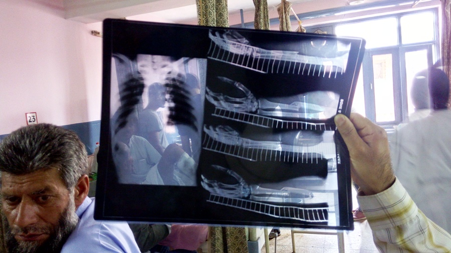 X-ray of an injured boy inside B&J hospital. (Pic: Bilal Handoo)