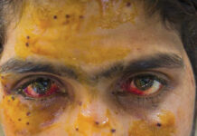 Eye Protest This boy was hit in the face by a pellet gunshot. (KL Image: Bilal Bahadur)