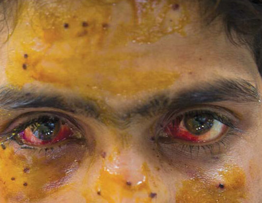 This boy was hit in the face by a pellet gunshot. (KL Image: Bilal Bahadur)