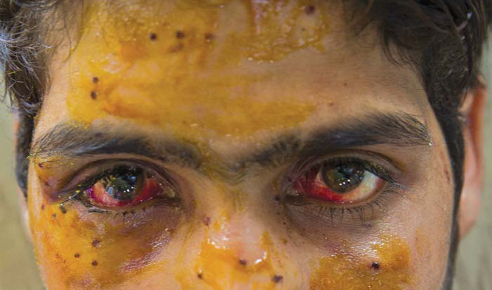 This boy was hit in the face by a pellet gunshot. (KL Image: Bilal Bahadur)
