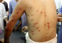 #Day18: 8 Persons Including A Lady Injured Due To Pellets in Islamabad The pellet injured of Islamabad being treated in the district hospital. (KL file Image: Shah Hilal)