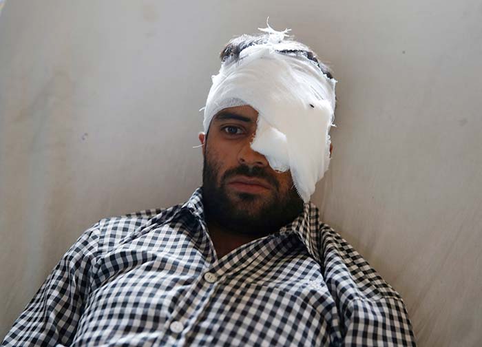 A pellet hit victim. (KL Image: Bilal Bahadur)