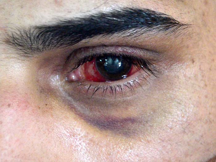 Pellet-injuries-(1)