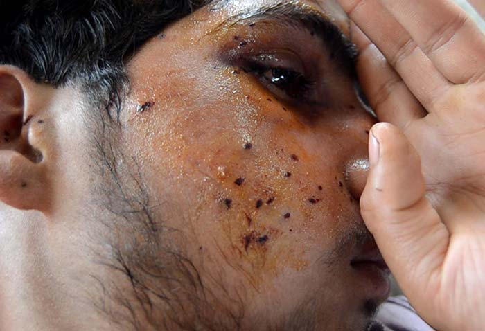 Pellet-injuries-(4)