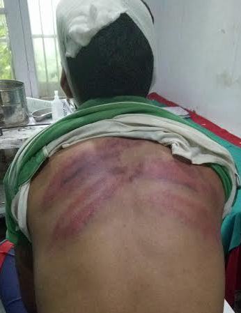 One of the injured in army action in Hardishiva admitted to SD Hospital Sopore. (KL Image: Muhammad Younis)