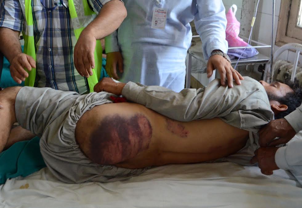 A person, who received back injuries, being treated in Srinagar's SMHS hospital on Thursday. Dozens of persons from Khrew –Pampore in South Kashmir’s Pulwama district were allegedly left injured after the army and Special Operation Group (SOG) raided their residences last night and beat them up ruthlessly A person, who received back injuries, being treated in Srinagar's SMHS hospital on Thursday. PHOTO BY BILAL BAHADUR