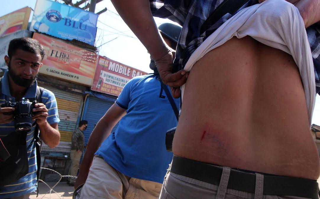 One of the injured photo-journalists in police action at Batamaloo on September 03, 2016.
