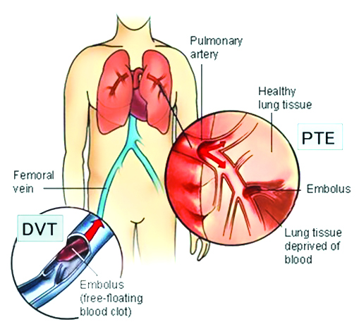 dvt-pte