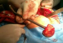 Hip replacement surgery done at SDH Kreeri: DHSK