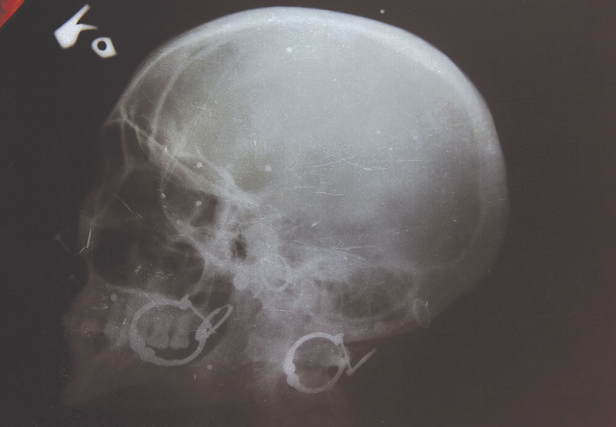 x-ray of Shakeela’s pelleted skull. (KL Image by Faisal Ahmed Fazeel)