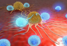 Caught by Cancer Cancer cells shown here with lymphocytes.