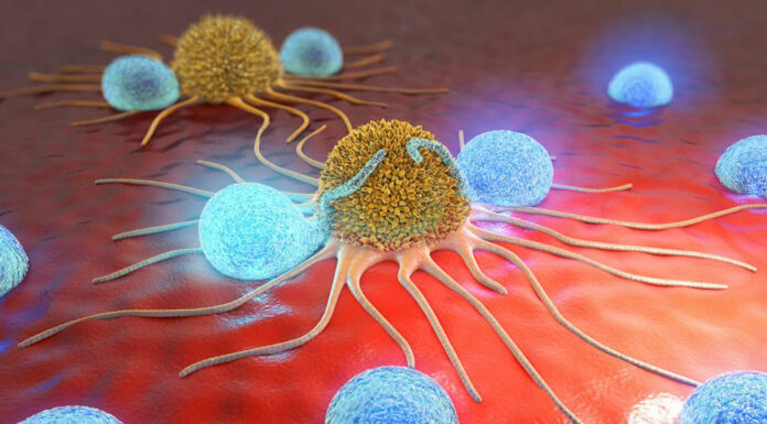 Cancer cells shown here with lymphocytes.