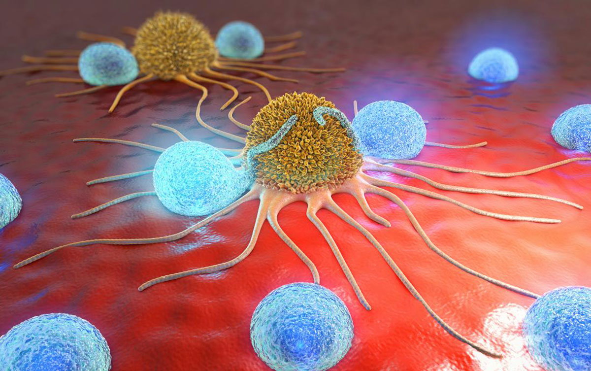 Cancer cells shown here with lymphocytes.