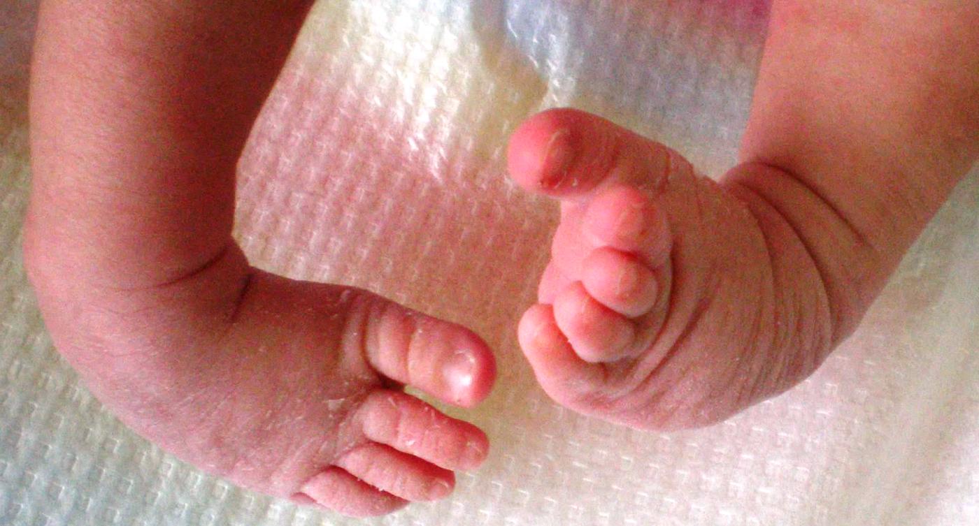 Newborn Baby Foot Problems and Deformities