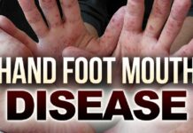 13 Cases Of Hand, Foot And Mouth Disease Reported In Srinagar
