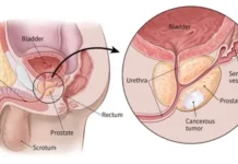 Prostate Cancer