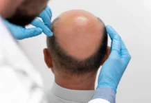 Medical Treatments Commonly Recommended for Male Pattern Hair Loss